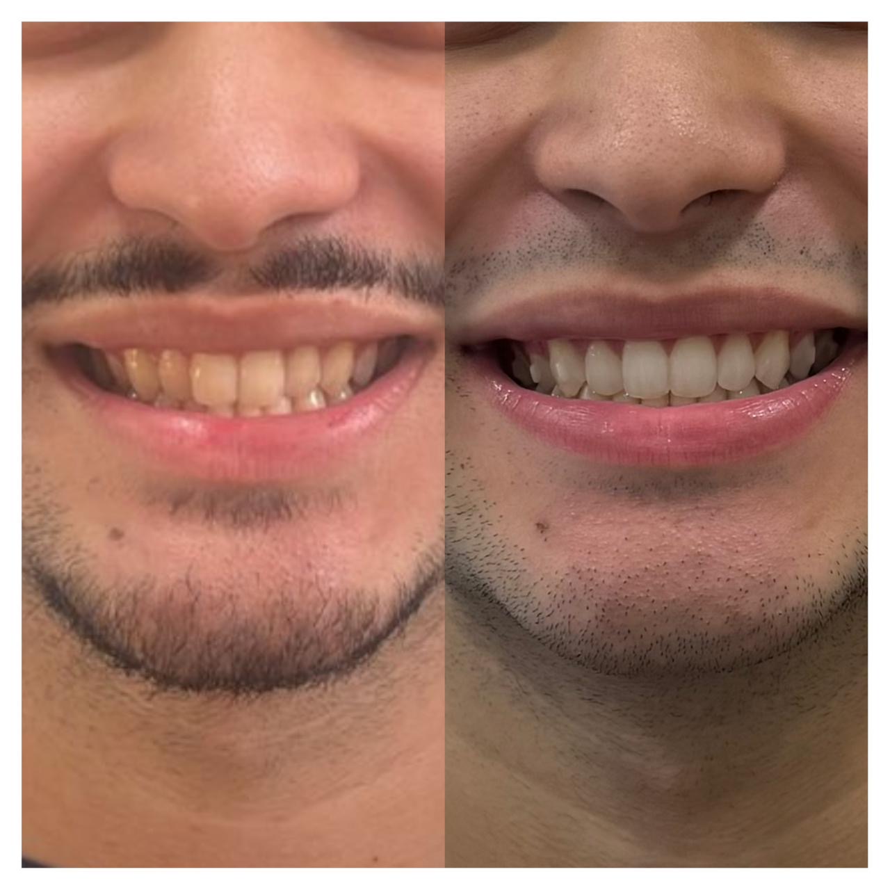 Antes e depois de clareamento dental realizado na Velvian