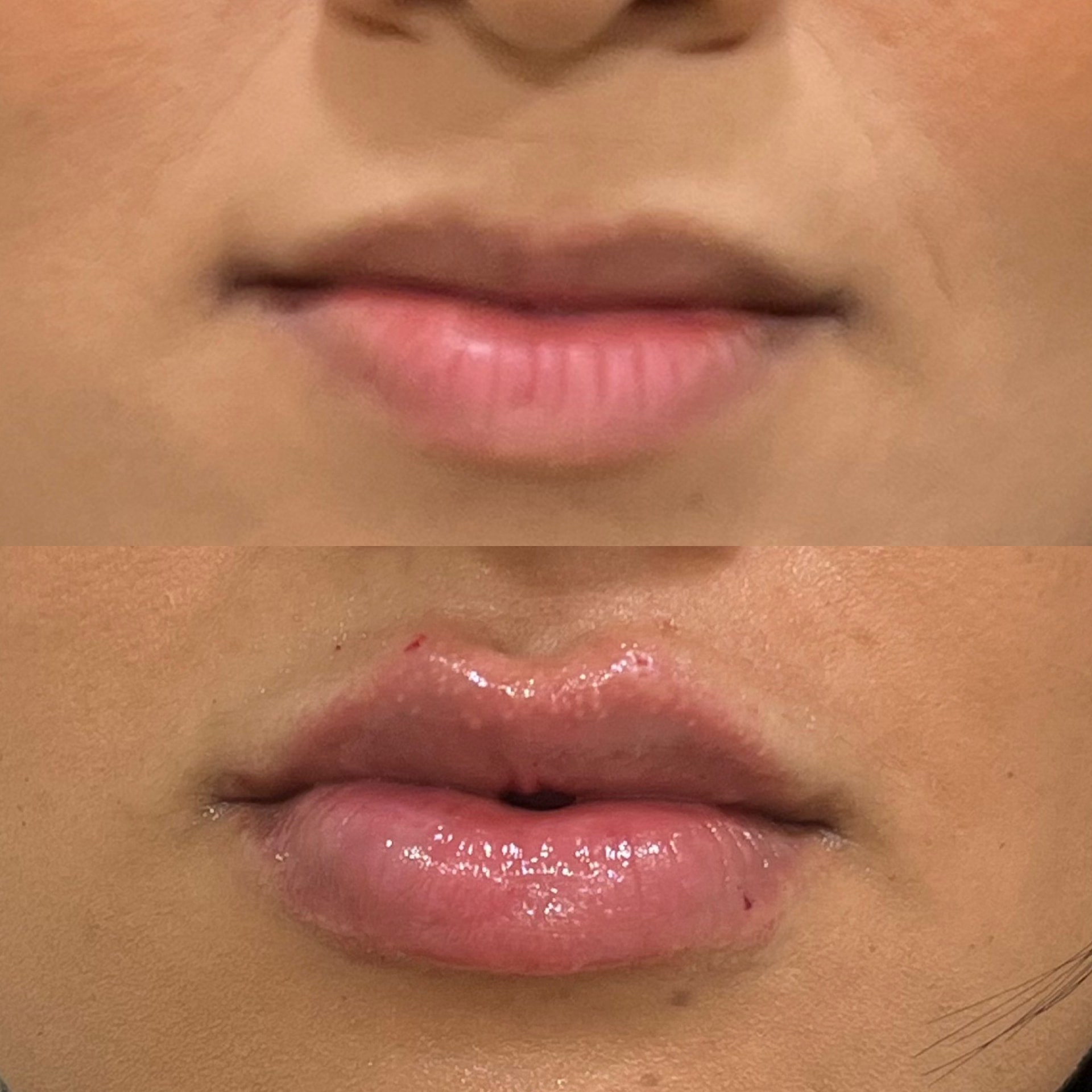 Antes e depois de preenchimento labial realizado na Velvian